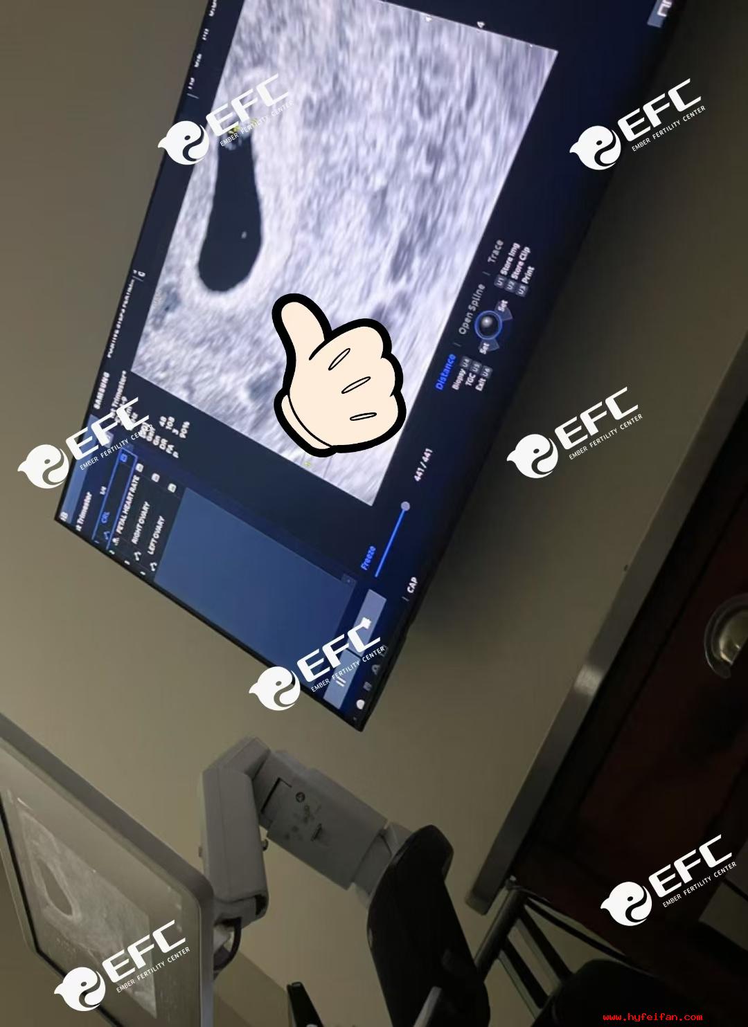 美国宝宝今日胎心顺利验收